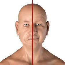 فلج بلز (Bell's Palsy): علل، علائم و نقش حیاتی فیزیوتراپی در بهبود عملکرد عصب صورتی زیر نظر دکتر پوریا محمدی