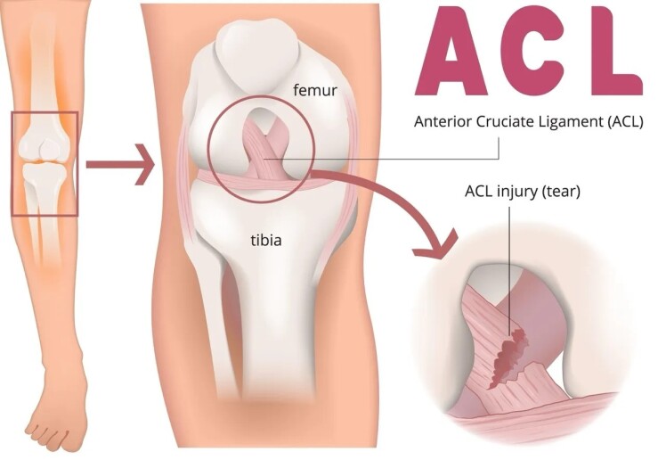 بازگشت به فعالیت بدون جراحی؛ درمان پارگی ACL زیر نظر دکتر پوریا محمدی در فیزیوتراپی پرتو فردیس