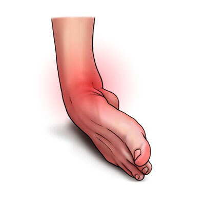 فیزیوتراپی مچ پا پس از پیچخوردگی در کلینیک پرتو فردیس |دکتر پوریا محمدی
